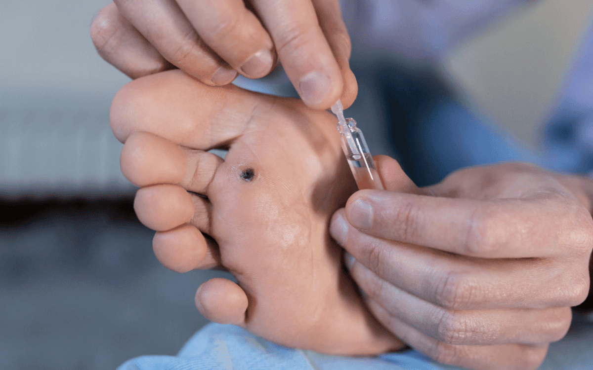 Plantar Warts vs. Calluses: How to Tell the Difference