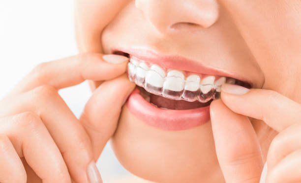 Clear Aligners for Adults: Are They Effective for All Ages?