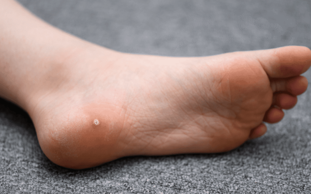 How Podiatrists Manage and Treat Plantar Warts Effectively