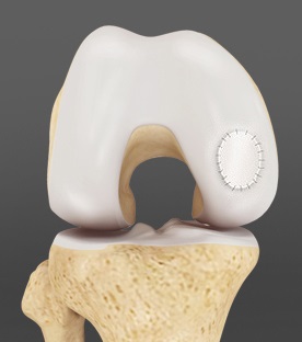 How Regenerative Orthopedics Is Used in Cartilage Repair