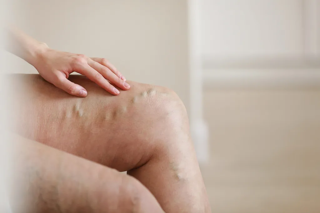 How Vein Care Affects Your Long-Term Health and Wellbeing