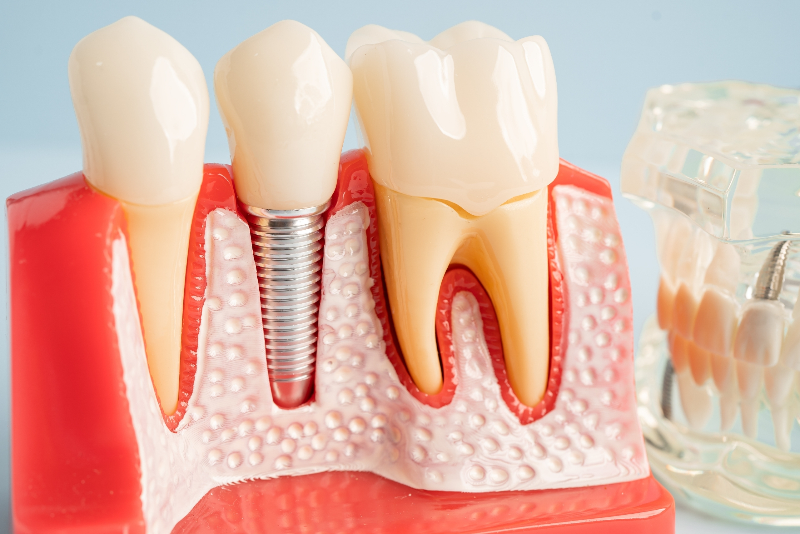 Success Rates of Dental Implant Surgery