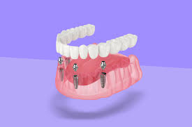 The Role of Dental Implants in Restorative Dentistry