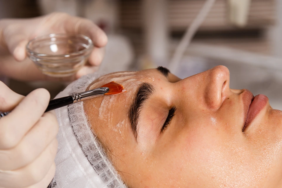 How Chemical Peels Address Hyperpigmentation