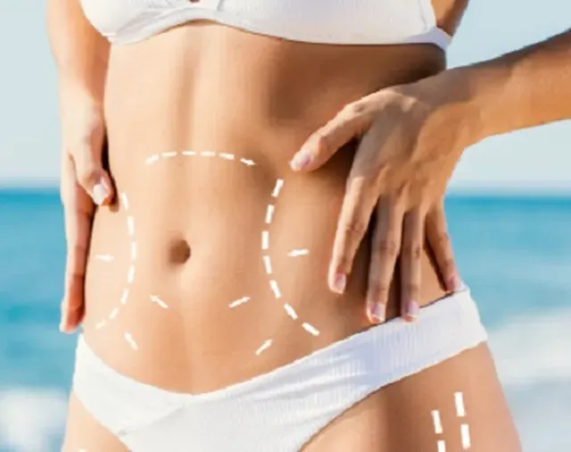 Tummy Tuck After Pregnancy: What to Know