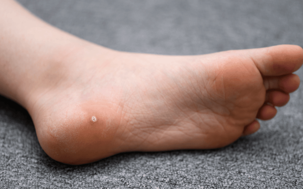 Effective Home Remedies for Removing Warts Safely