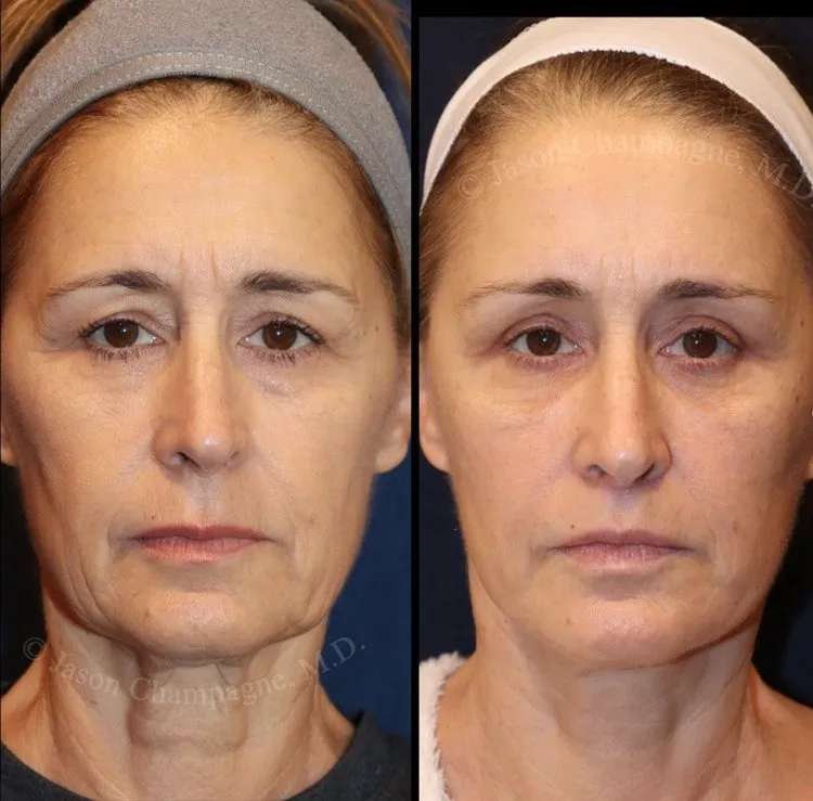 The Long-Term Benefits of a Face Lift