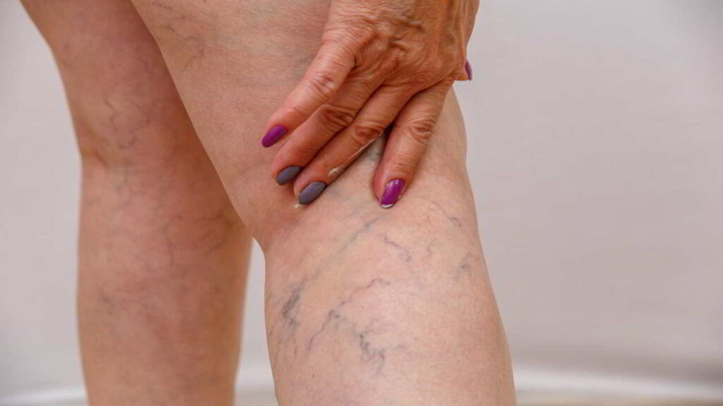 Understanding Varicose Veins and How To Treat Them