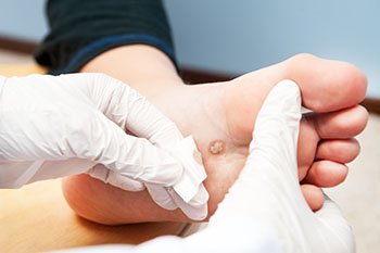 What You Need to Know About Plantar Warts and the Treatments Available
