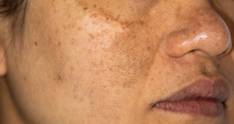 What a Skin Doctor Can Do for Hyperpigmentation Issues