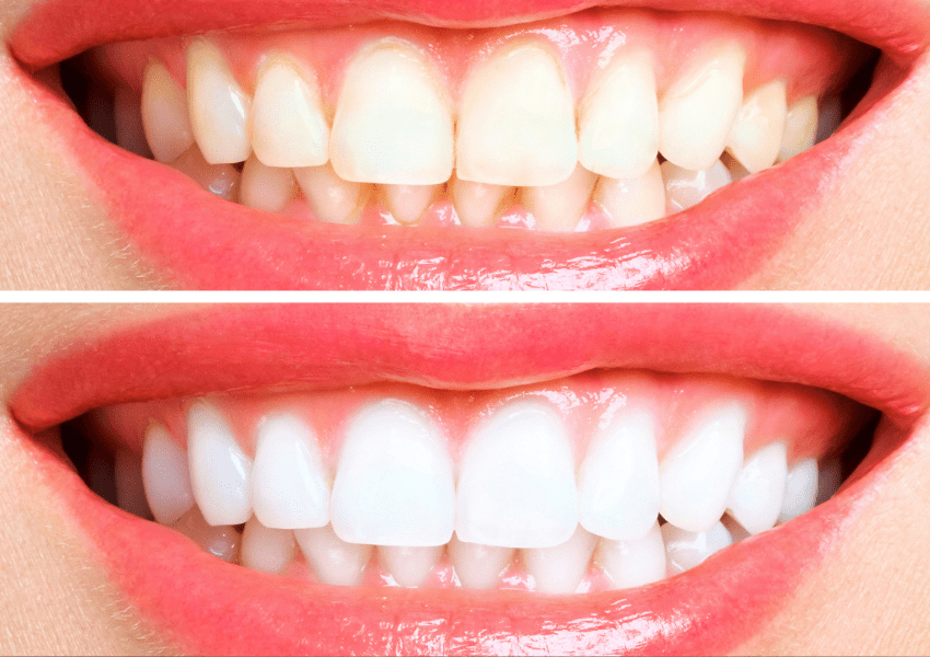 2 Different Teeth Whitening Methods
