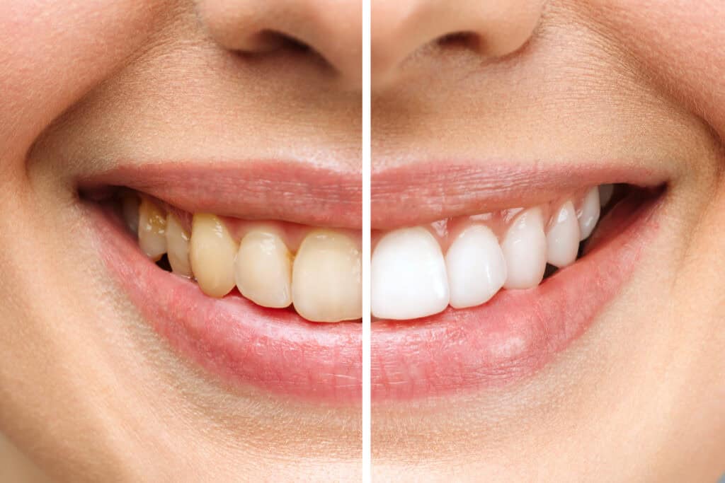How Teeth Whitening Affects Your Smile