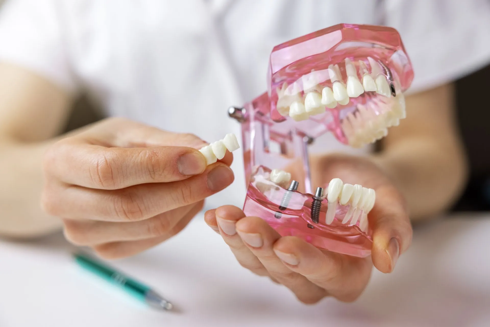 Choosing the Right Dentures for Your Lifestyle
