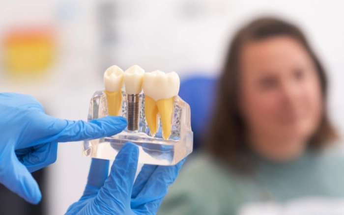 The Lifespan of Dental Implants